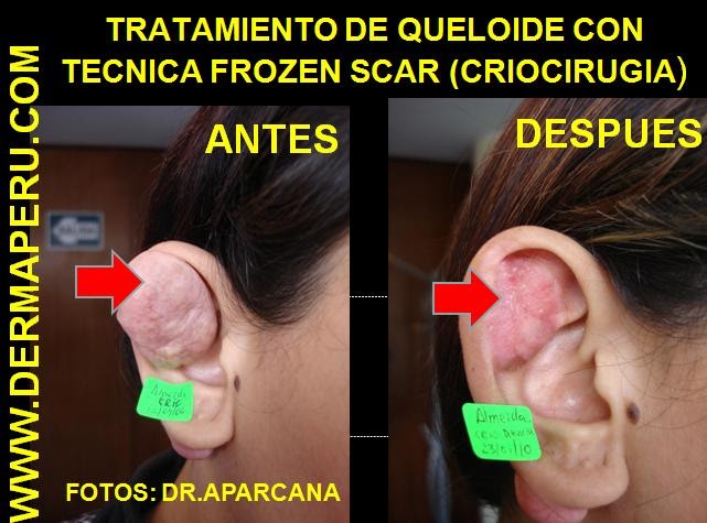 Puede ir sobre la cabeza la psoriasis